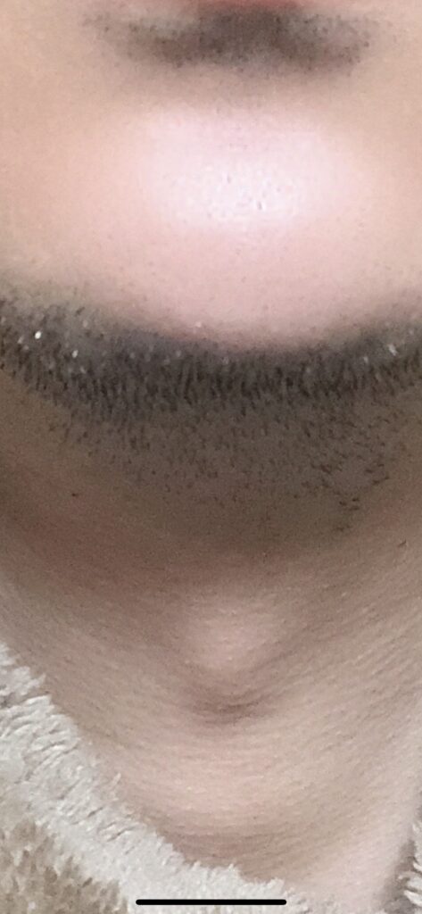 脱毛後顎髭の画像